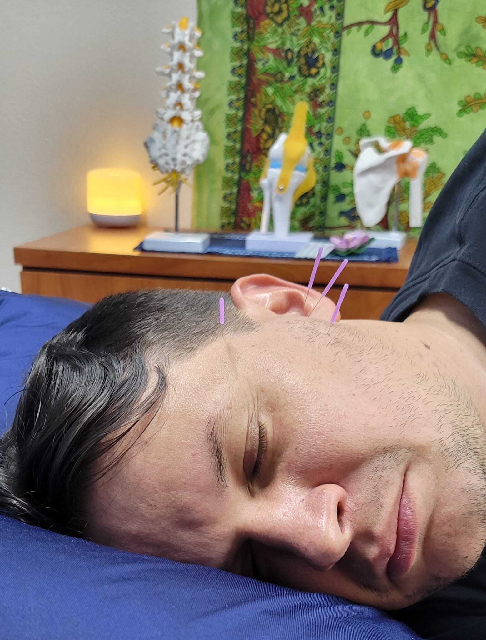 Dry Needling